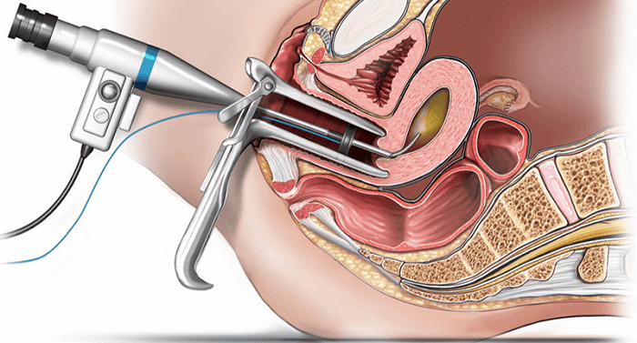 Artificial Insemination Tratment in Pune