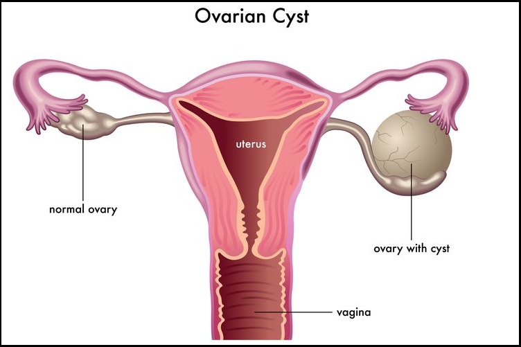 Hysterectomy Clinic in Pune